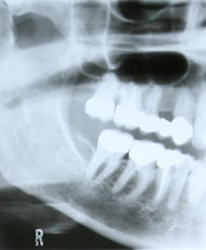 Zahnarzt Martin Gross Bahlingen Zahnerhaltung